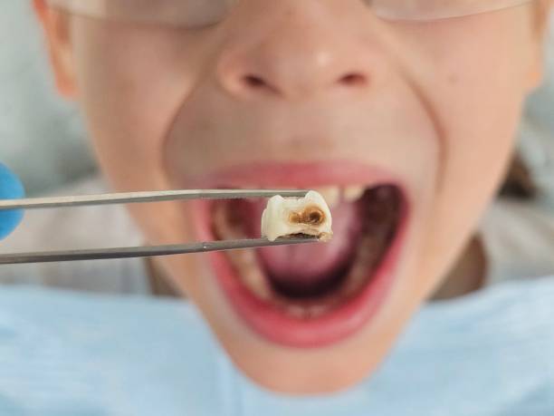 Best Emergency Treatment for Dental Infections or Abscesses in Temperance, MI